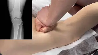 Почему болят колени?! Как вылечить в домашних условиях. 