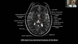 Neuroanatomy of the Basal Nuclei and Pathophysiology of Parkinsonism