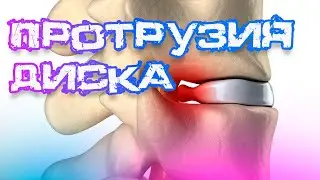 💡Протрузия диска: ЧТО это такое и КАК избавиться от БОЛИ? | Ответы на ваши вопросы.
