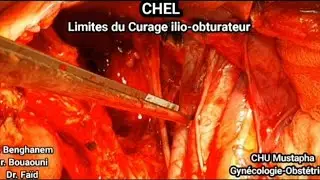 CHEL : limites du Curage ilio-obturateur