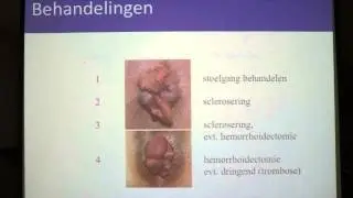 Aambeien - proctologie - Dr. Tom Feryn