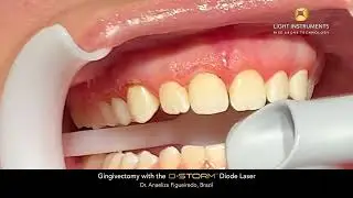 Gingivectomy with the D-Storm™ Diode Laser