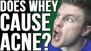 Does Whey Protein Cause Acne?