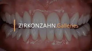 Prettau® 3 Dispersive® – Optimal function thanks to additional steps | Zirkonzahn.Galleries