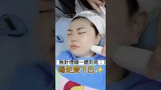Liftera-V lift無針埋線 SaMuu Beauty單次收費美容🌞✨