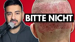 Grafts von zu weit oben entnommen | Haare werden nach FUE Haartransplantation ausfallen