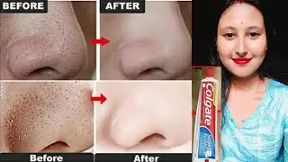 মাত্ৰ দুটা বস্তুৰে ঘৰতে Remove কৰক blackheads আৰু whiteheads ! ৰিজাল্ট দেখি আচৰিত হ'ব ।  #blackheads