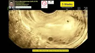 5 Weeks Gestasional Sac