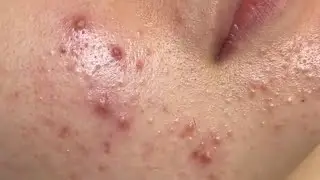 pimple popper blackhead remove