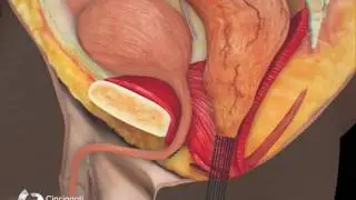 Surgical Treatment of Bulbar Urethral Fistula | Cincinnati Children's