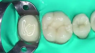 LuxaCore Z Dual Posterior Tooth Core Build-Up