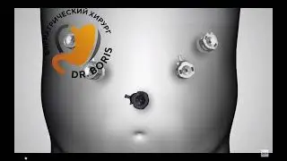 Минишунтирование желудка, OAGB (One Anastomosis Gastric Bypass)