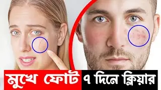 ছাফী - ব্রণ ও মুখে ফোট ওঠা ৭ দিনে ক্লিয়ার