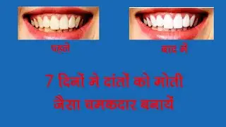Teeth Cleaning Tips ! Whitening Teeth मसूड़ों में दर्द का इलाज ! पीले दातों को सफेद कैसे बनाएं