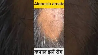 Alopecia areata#skincare #shorts #health