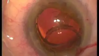 Имплантация составного искусственного хрусталика_7