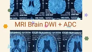 MRI brain DWI plus ADC signifacance.. stroke detection on MRI #Video 2