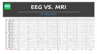 An Interesting Comparison of An EEG and an MRI.