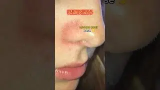 The TRUTH About YOUR SKIN REDNESS ❗️