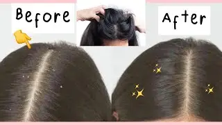 TERAMPUH SEPANJANG MASA KETOMBE BYE!! CUKA APEL DAN ESSENTIAL OIL👍🏻MENGHILANGKAN KETOMBE | nadiSSE