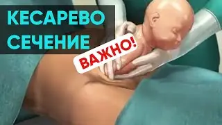 Cesarean Section. Nika Bolzan
