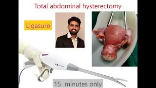 TOTAL ABDOMINAL HYSTERECTOMY SKIN TO SKIN USING LIGASURE IN 15 MINUTES ONLY (FASTEST HYSTERECTOMT)