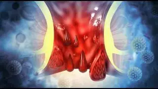 How long do Anal Fissures last? | Do Anal Fissures go away? | Apollo Hospitals