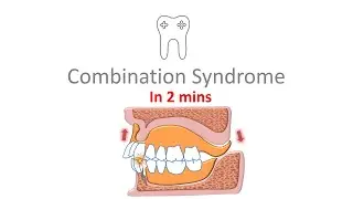Combination Syndrome in 2 mins