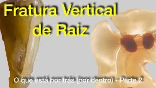 Fratura Vertical de Raiz - O que está por trás (por dentro) - Parte 2