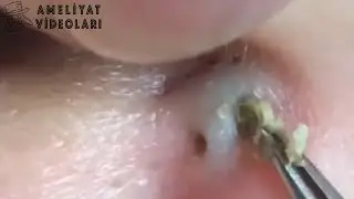 Kulaktaki inanılmaz siyah nokta ( Rahatlatıcı ) #earblackheads