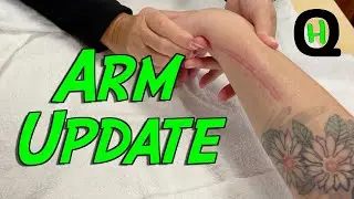 Surgery Recovery Update (((Come with Me to Occupational Therapy!)))