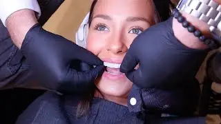 I got VENEERS | ft. my new smile
