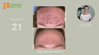 21. Акне тяжелая степень акне  (до и после)