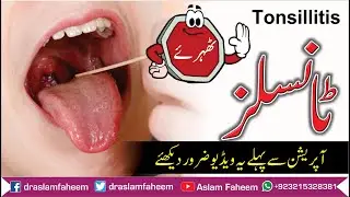 Tonsillitis Causes, Diagnosis & Treatment | How to Remove Tonsils without Surgery | ٹانسلز کا علاج