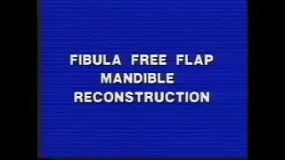 Fibula Free Flap Mandible Reconstruction I&II