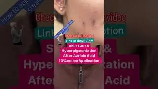 Skin burns and hyperpigmentation after azelaic acid cream 