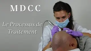 Le processus du traitement de la Micropigmentation des Cheveux chez MDCC Hair Clinic