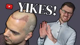 Remove Scabs After Hair Transplant (WHEN and HOW)