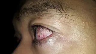 Viral nyaris buta akibat radiasi handphone