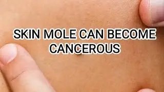 SKIN MOLE CAN BECOME CANCEROUS...SO BE CAREFUL