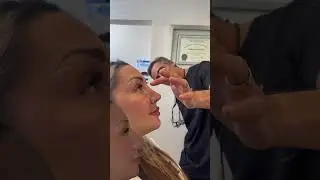 Dorsal Hump Rhinoplasty Results | Anthony Bared MD, FACS | Miami, FL