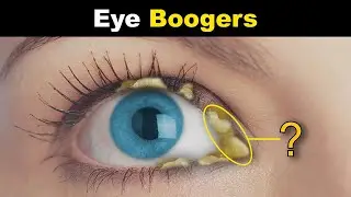 What Are Eye Boogers? | Eye Discharge (Rheum) In Eyes