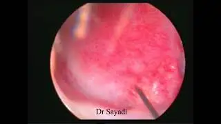 Coagulation tâche vasculaire