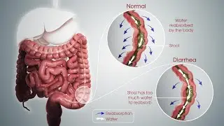 RETENTION OF COLD DAMPNESS, RETENTION OF DAMP HEAT DIARRHEA
