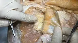 TEMPORAL FOSSA Muscle Fascia Vessels PTERION EDH and Clinical Aspects – Sanjoy Sanyal