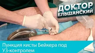 Пункция кисты Бейкера под УЗ контролем с введением дипроспана