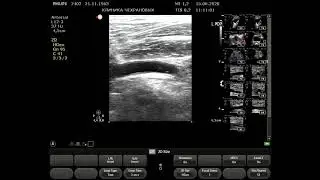 Ultrasound of the arteries of the lower extremities: norms, 2020, 06/15/11, 