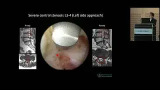 Case Presentation – Lumbar Central Canal Stenosis / RIWOspine Global Endoscopic Spine Days 2023