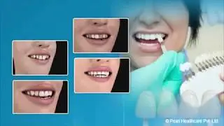 Dental Veneer