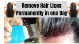 how to remove lice and nits from hair permanently